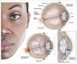 glaucoma